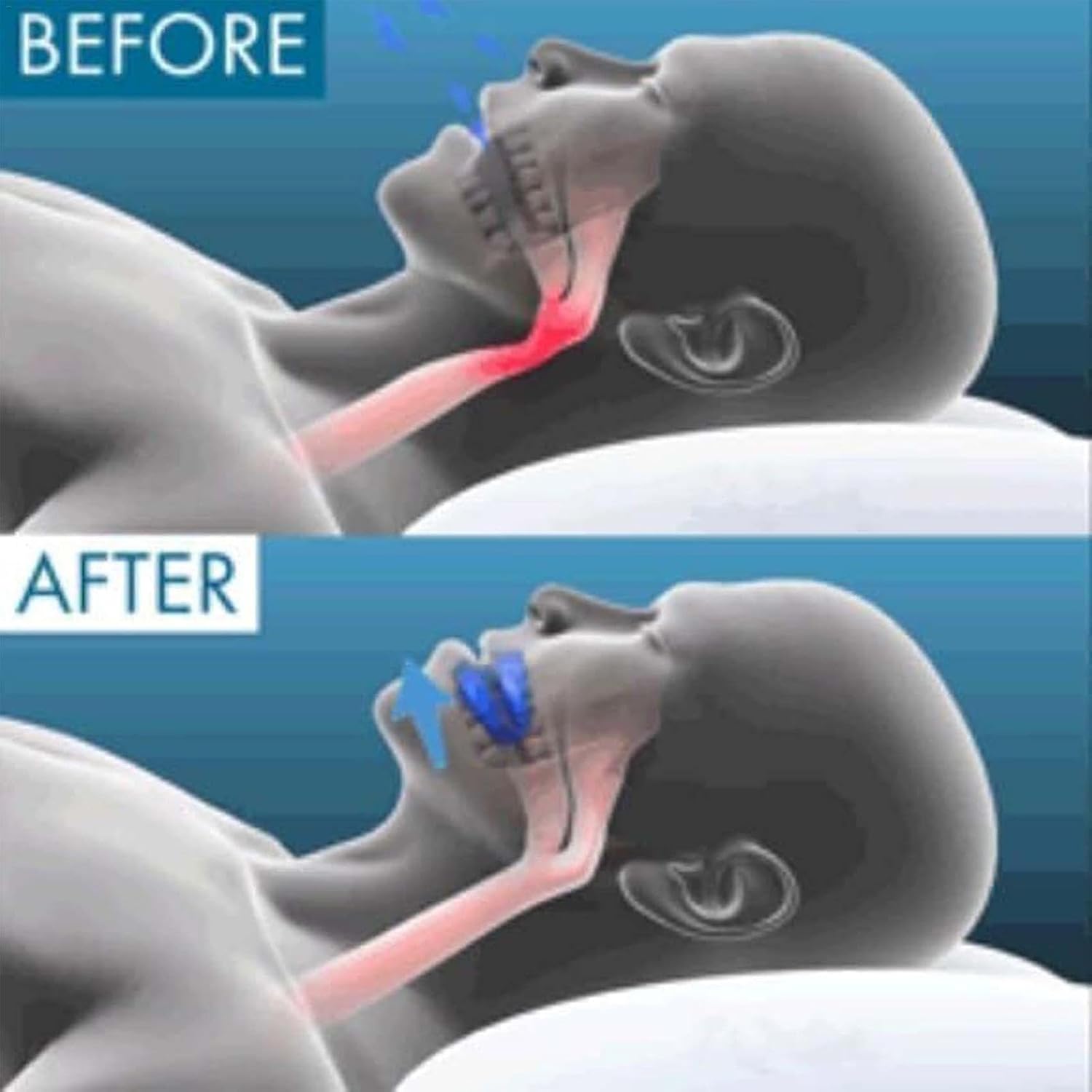 Orthèse buccal Anti Ronflement | BF