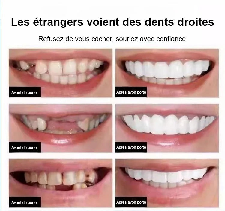 Souriez à Nouveau en Toute Confiance – Prothèse Dentaire Custom‑Fit